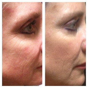 6 weeks post 1st SkinPen treatment